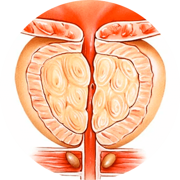 Folgen einer unbehandelten Prostatitis