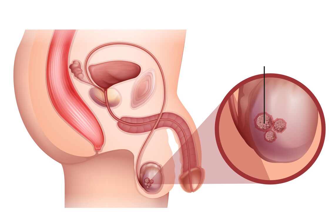 Anzeichen von Prostatakrebs