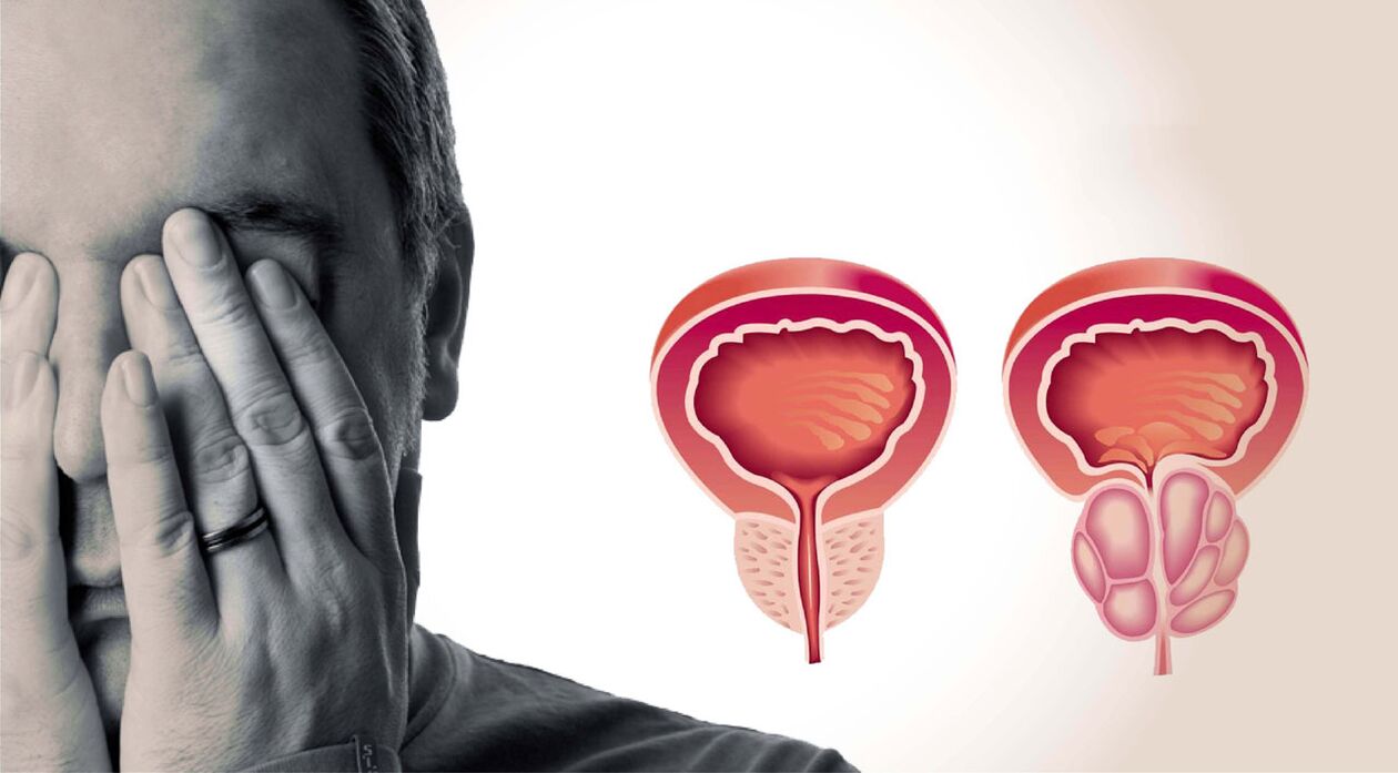 chronische Prostatitis bei Männern