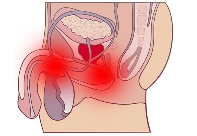 Methoden zur Behandlung von Prostatitis