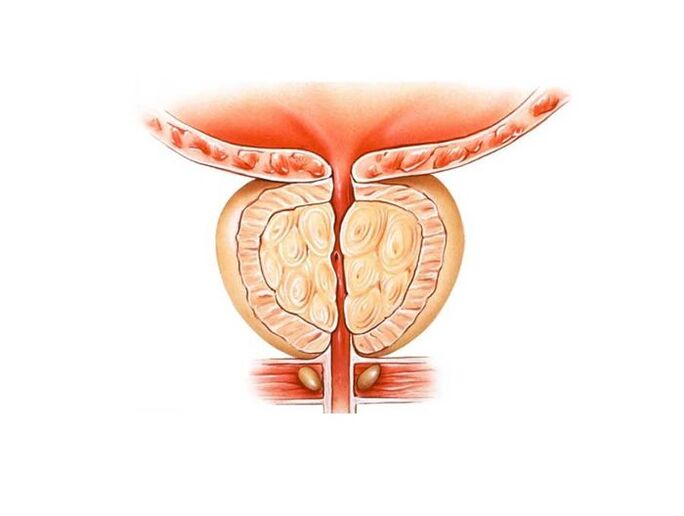 Prostatitis-Behandlung mit Hausmitteln