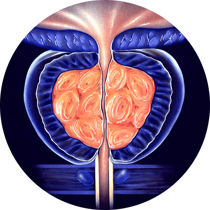chronische Prostatitis